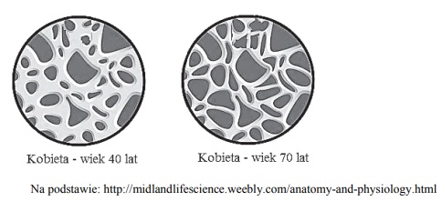 Przyczyna osteoporozy u kobiet.