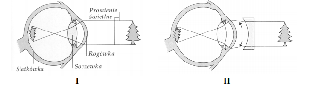 Krótkowzroczność – przyczyny i sposób korekcji.
