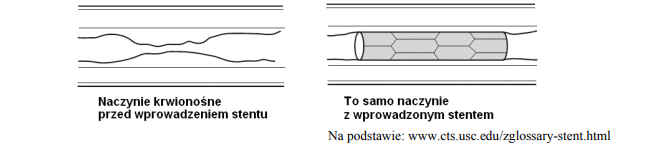 Mechanizm działania stentów.